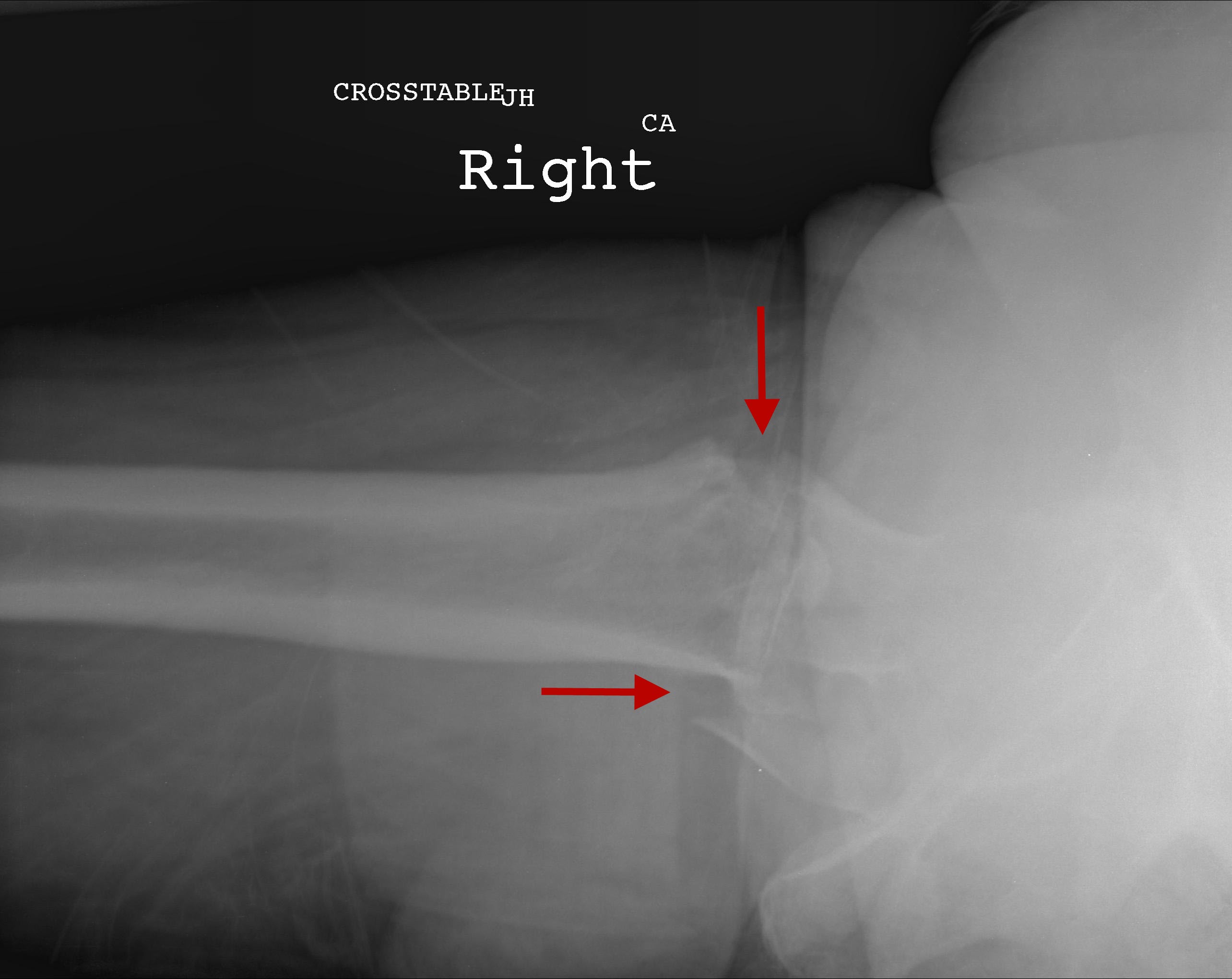 left hip intertrochanteric fracture icd 10