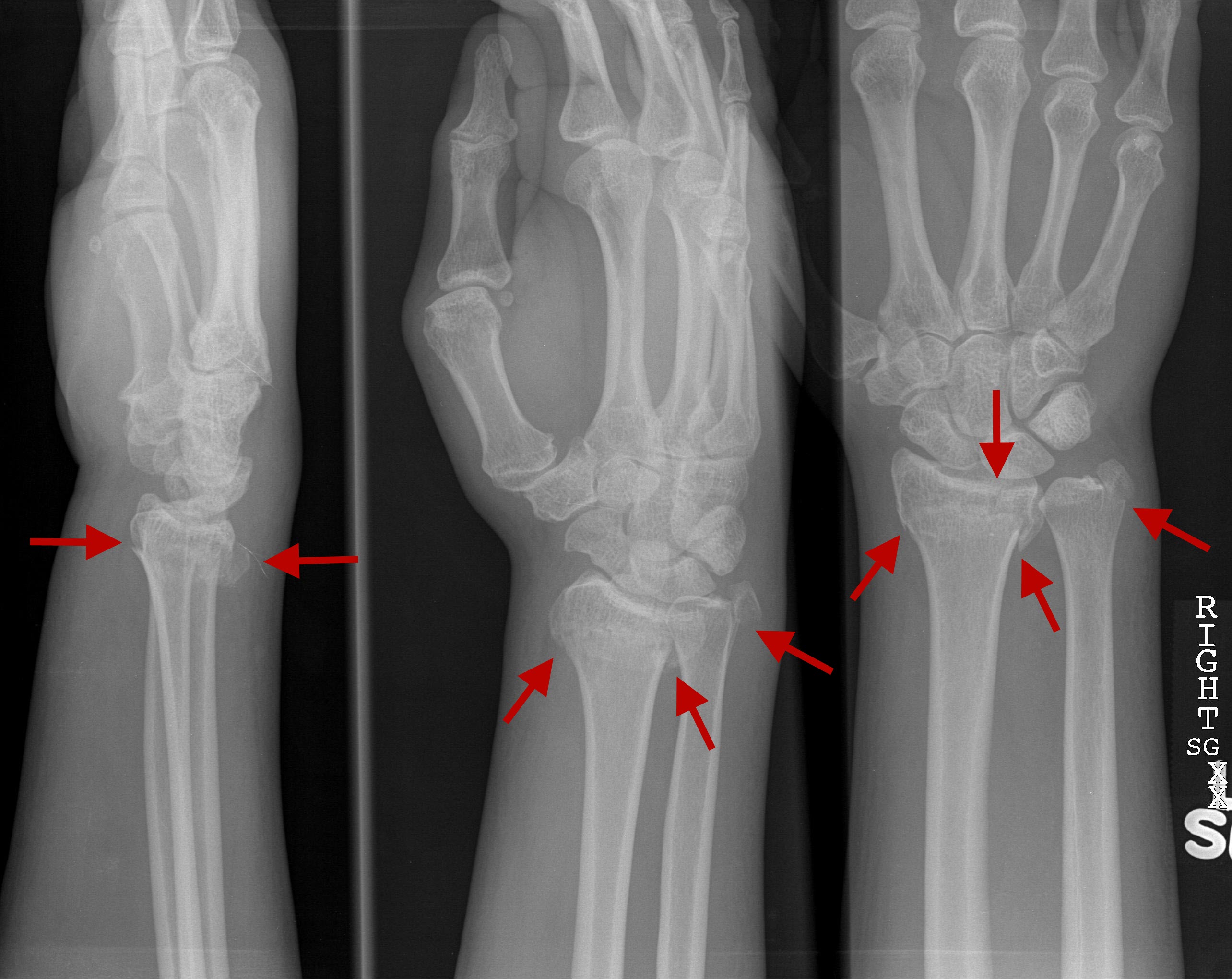 acute buckle fracture wrist
