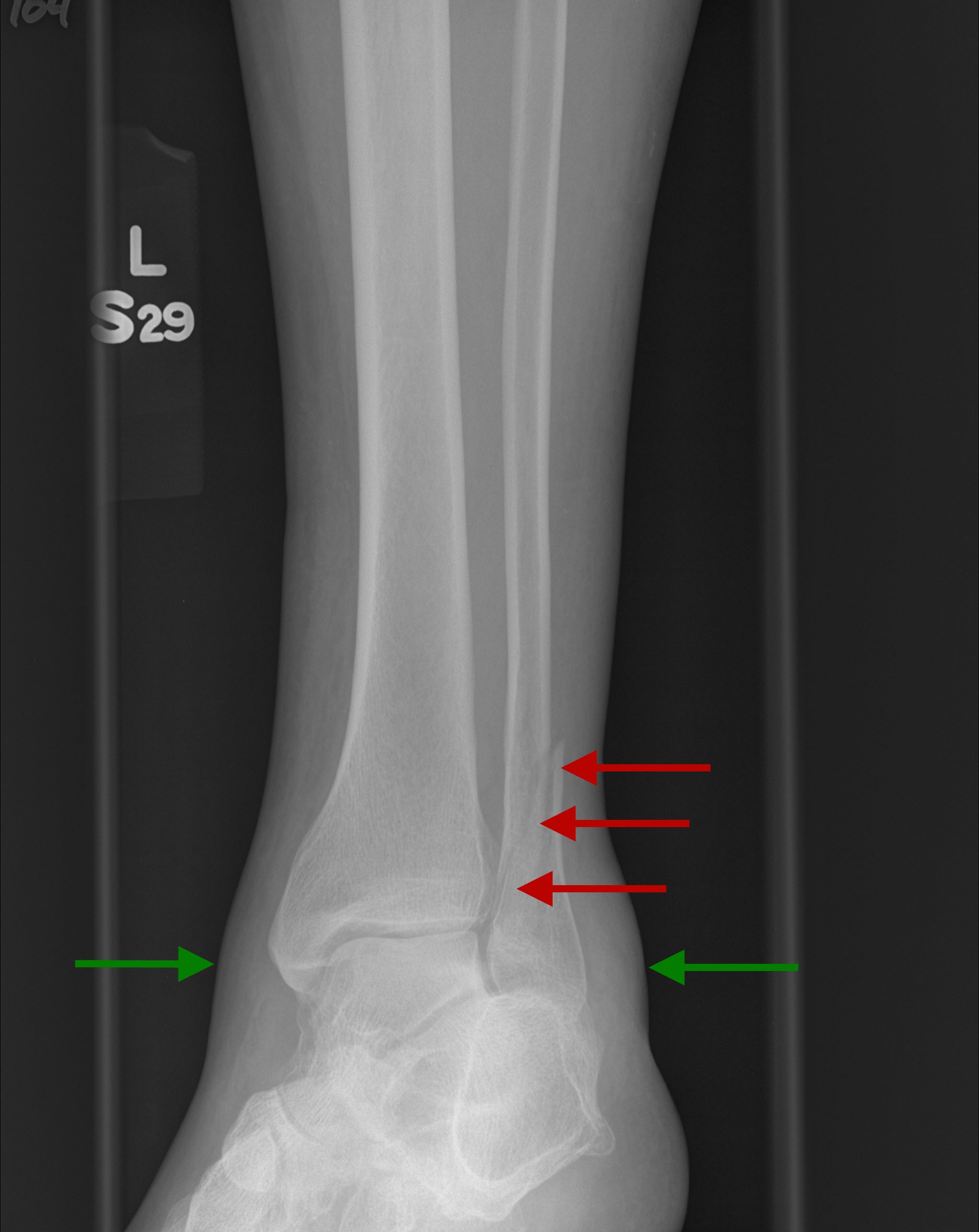 What is an isolated distal fibula fracture?